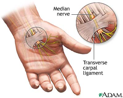 Carpal Tunnel Syndrome - Washington Orthopaedics & Sports Medicine