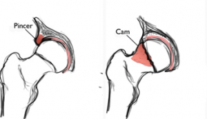 labral hip tear