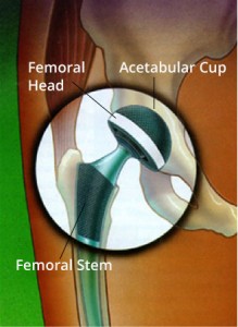 anterior hip replacement