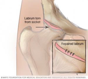 hip tear at base of labrum