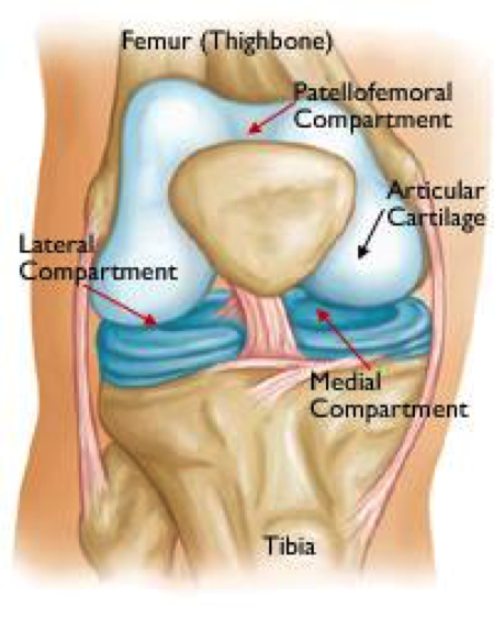 Arthritis is commonly found in the medial compartment