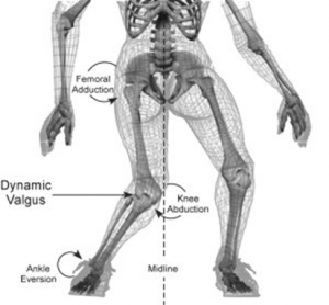 Females often twist further away from the midline of the leg than males when landing, thus creating more stress on the ACL (http://www.medbridgeeducation.com/blog/tag/acl-reconstruction/)