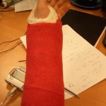 wrist injury cast