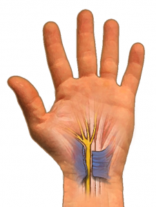 Cut transverse carpal ligament