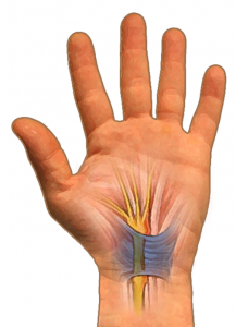 Intact transverse carpal ligament 