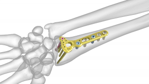 Internal plates and screws for fixing a distal radius fracture