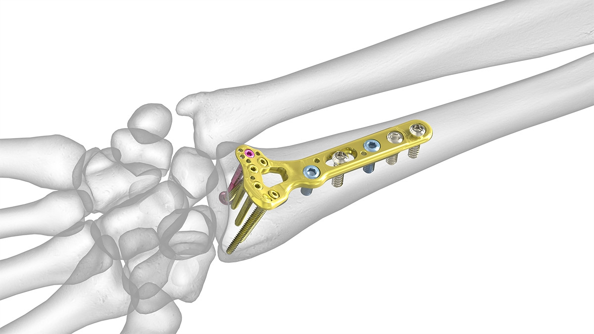 Treating and Preventing Wrist Fractures Washington Orthopaedics