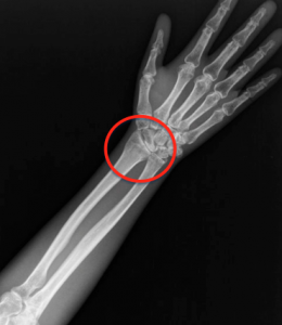 wrist fracture