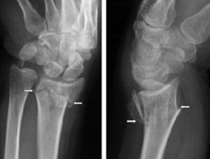 distal radius fracture