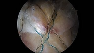 rotator cuff repair