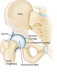 hip dysplasia