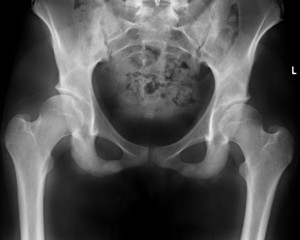 Example of hip joints with shallow sockets