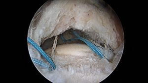 torn rotator cuff tendon