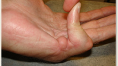 dupuytrens contracture
