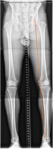 Osteotomy