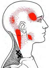 trigger points of myofacial pain