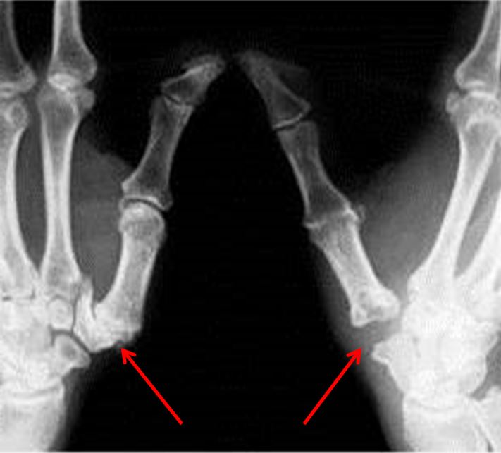 On the left is an arthritic thumb basilar joint; on the right is what it looks like after surgery