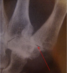 Arthritic thumb basilar joint