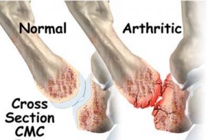 Normal cartilage (left) Worn-out cartilage (right)