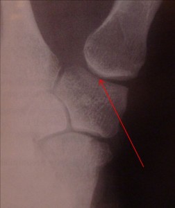 Normal thumb basilar joint