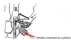 Surgical Procedure from the J Hand Surg 11A:324-32, 1986