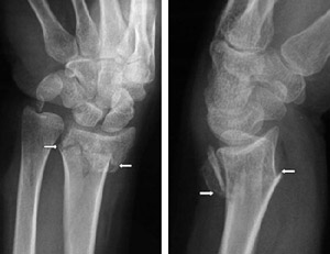 X-rays of a fractured distal radius