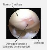 cartilage