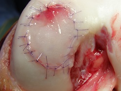 autologous cartilage transplantation 