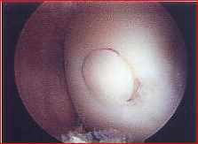 osteochondral-transfer